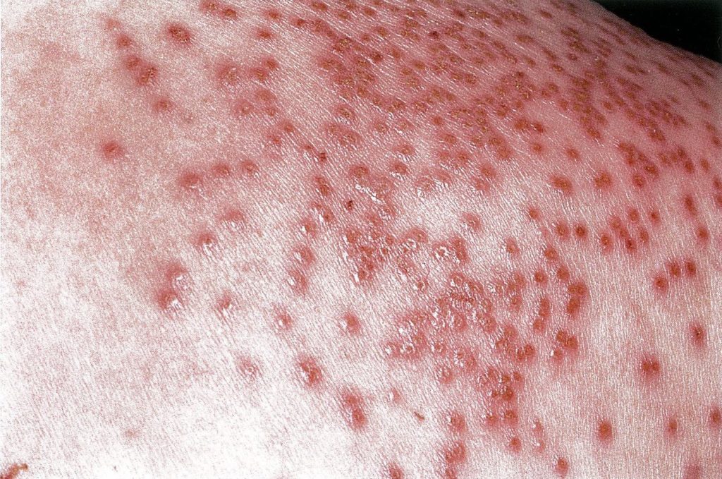 مامی گل درمان زگیل تناسلی و تبخال تناسلی با روش تضمینی در شرق تهران پیروزی